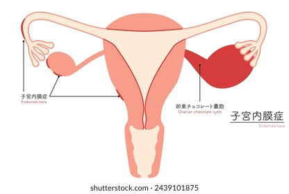 Diagrammatic illustration of endometriosis, anatomy of the uterus and ovaries, Vector Illustration