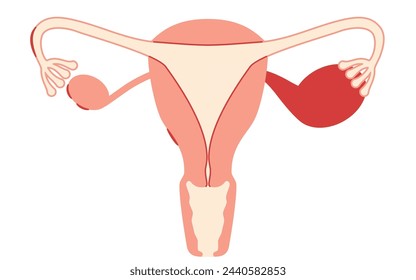 Diagrammatic illustration of endometriosis, anatomy of the uterus and ovaries, Vector Illustration