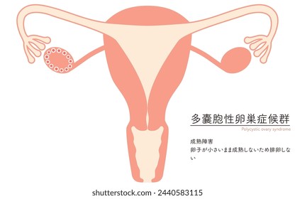 Diagrammatic illustration of polycystic ovary syndrome (maturation disorder), anatomy of the uterus and ovaries - Translation: Maturation failure Failure to ovulate because the oocyte remains small an