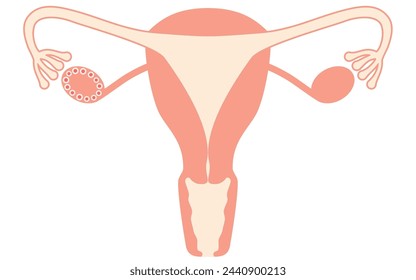 Diagrammatic illustration of polycystic ovary syndrome (maturation disorder), anatomy of the uterus and ovaries - Translation: Maturation failure Failure to ovulate because the oocyte remains small an