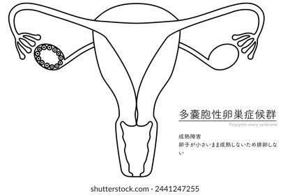 Diagrammatic illustration of polycystic ovary syndrome (maturation disorder), anatomy of the uterus and ovaries - Translation: Maturation failure Failure to ovulate because the oocyte remains small an