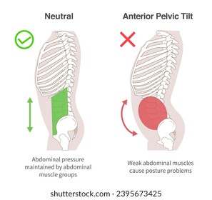 Diagrammatic illustration of the relationship between abdominal muscle groups, abdominal pressure, and Anterior Pelvic Tilt in sideways