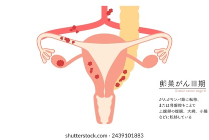 Diagrammatic illustration of stage III ovarian cancer, anatomy of the uterus and ovaries, anatomy of the uterus and ovaries - Translation: Cancer has spread to the lymph nodes or across the pelvic cav