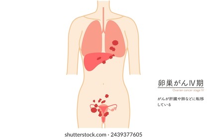 Ilustración de la etapa IV del cáncer de ovario, anatomía del útero y los ovarios, anatomía del útero y los ovarios - Traducción: El cáncer se ha extendido al hígado, los pulmones, etc.