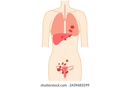 Diagrammatic illustration of stage IV ovarian cancer, anatomy of the uterus and ovaries, anatomy of the uterus and ovaries - Translation: Cancer has spread to the liver, lungs, etc.