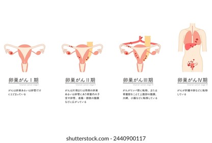 Diagrammatic illustration of stage I ovarian cancer, anatomy of the uterus and ovaries, anatomy of the uterus and ovaries - Translation: Cancer is confined to the ovaries or fallopian tubes