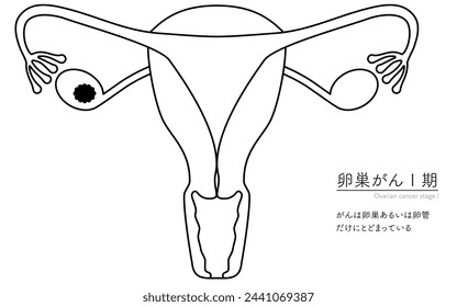 Diagrammatic illustration of stage I ovarian cancer, anatomy of the uterus and ovaries, anatomy of the uterus and ovaries - Translation: Cancer is confined to the ovaries or fallopian tubes