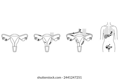 Diagrammatic illustration of stage I ovarian cancer, anatomy of the uterus and ovaries, anatomy of the uterus and ovaries - Translation: Cancer is confined to the ovaries or fallopian tubes