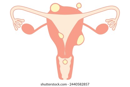 Diagrammatic illustration of uterine fibroids, anatomy of the uterus and ovaries, Vector Illustration