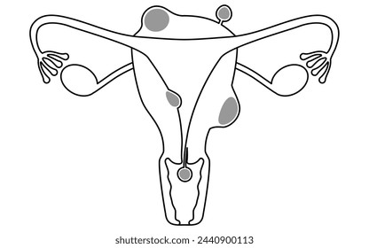 Diagrammatic illustration of uterine fibroids, anatomy of the uterus and ovaries, Vector Illustration