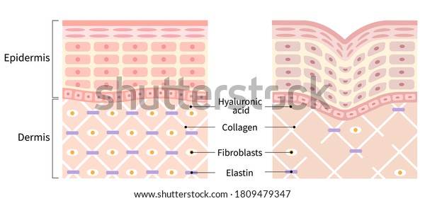 diagrams of young skin and winkle. young skin\
is firm tight, its collagen framework is healthy. old skin sags as\
it loses its support\
structure.