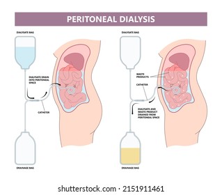 dialysate cleansing home care tube fluid drain bag waste High blood cysts center manual port End Stage renal ESRD Infusion Diffusion fatty liver tap cancer B C Use pain cavity portal peritoneocentesis
