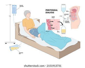 dialysate cleansing home care tube fluid drain bag waste High blood cysts center manual port End Stage renal ESRD Infusion Diffusion fatty liver tap cancer B C Use pain cavity portal peritoneocentesis