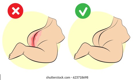 Schwellere Dermatitis Baby. Rötung am Boden des Kindes. Das Bild zeigt eine Hautkrankheit auf dem Baby, Diathese, Ekzem. Vorbeugung und Behandlung von kinderfreundlichem Hautausschlag.