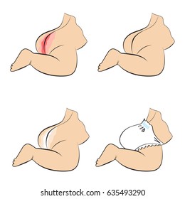 Diaper Dermatitis Baby. Redness On The Child's Bottom. The Image Shows A Skin Disease On The Baby, Diathesis, Eczema. Prevention And Treatment Of Children's Diaper Rash.