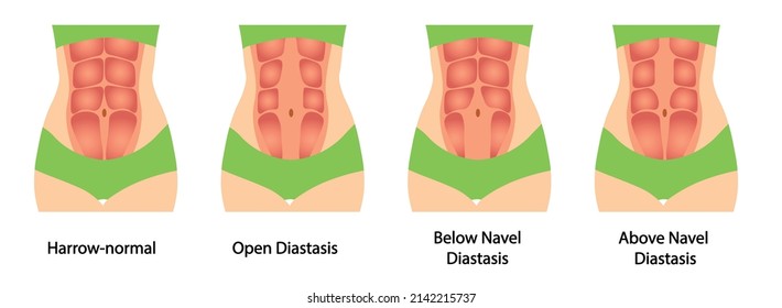 Diastasis illustration. Different types of diastasis. Abdomen wall muscle separation 