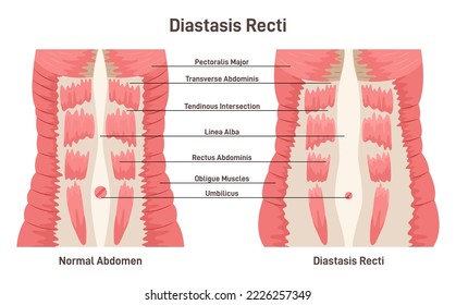 Diastasis rect. Abdominal muscles separation. Human torso muscles anatomy. Postpartum medical condition. Flat vector illustration