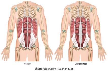 Diastasis recti 3d medical vector illustration on white background