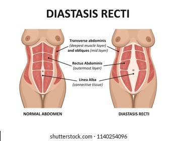 Diastasis recti. Abdominal muscle diastasis after pregnancy pregnancy and childbirth. 