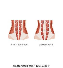 Diastasis Recti. Abdominal Muscle Diastasis After Pregnancy. Abdominal Problems. Anatomy Vector Illustration.