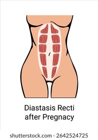 Diastasis Recti após a gestação em uma mulher. A anatomia de uma mulher. Espartilho muscular feminino após o parto. Ilustração vetorial

