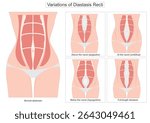Diastasis recti is a condition where the rectus abdominis the six-pack muscles separate along the midline of the abdomen due to the stretching of the linea alba.Variations of diastasis recti.
