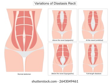 Diastasis recti is a condition where the rectus abdominis the six-pack muscles separate along the midline of the abdomen due to the stretching of the linea alba.Variations of diastasis recti.