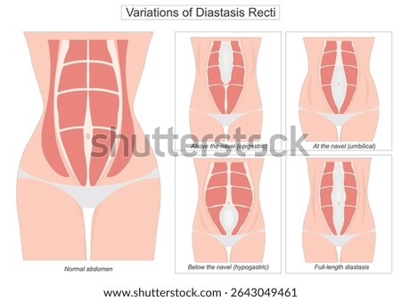 Diastasis recti is a condition where the rectus abdominis the six-pack muscles separate along the midline of the abdomen due to the stretching of the linea alba.Variations of diastasis recti.