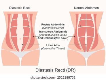 La diástasis rectal (RD) es una afección en personas embarazadas y en puerperio. Ocurre cuando los músculos abdominales del recto (músculos abdominales de seis paquetes) se separan durante el embarazo de ser estirados.