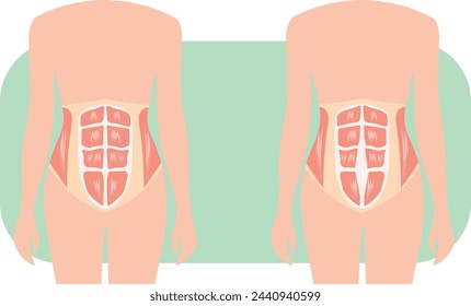 diastasis recti, external and internal view, normal and abnormal condition