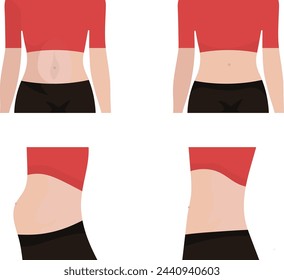 diástasis rectal, vista externa e interna, estado normal y anormal