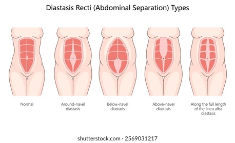 diastasis recti, including around-navel, below-navel, above-navel, and full-length abdominal separations diagram hand drawn schematic vector illustration. Medical science educational illustration