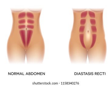 Diastasis recti also known as abdominal separation, it is common among pregnant women. There is a gap between the rectus abdominis muscles.