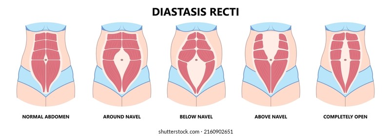 Diastasis Recti Six Pack Separation Belly Rectus Linea Alba Abdominal Surgical Tummy Tuck Skin Fat Loss C Section Ovary Over Consuming Bloated Stressed Out Childbirth