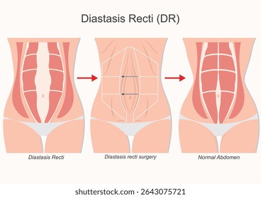 Diastasis recti surgery often part of a tummy tuck (abdominoplasty) is a procedure to repair the separation of the rectus abdominis muscles, commonly referred to as the six-pack muscles.Medical  