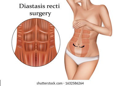 Diastasis  Recti  Surgery (stretching of the linea alba). Abdominoplasty