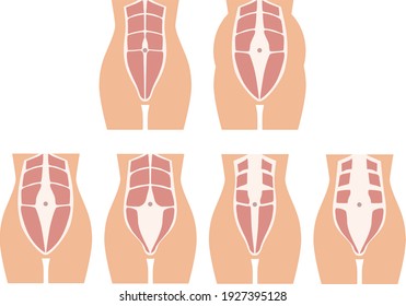 diastasis in a woman after pregnancy and childbirth. increased distance between the rectus abdominis muscles in a woman after childbirth. muscle corset of a woman after childbirth.