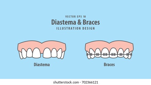 Diastema & Braces illustration vector on blue background. Dental image.