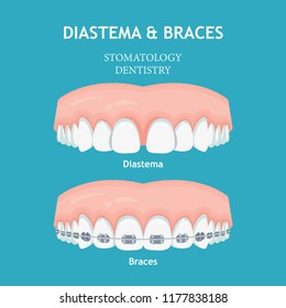 Diastema Braces vector. Stomatology dentistry vector concept