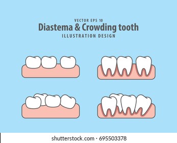 Diastema 