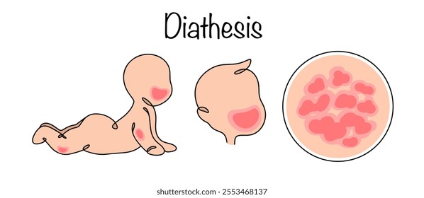 Diathesis. The body's predisposition to certain diseases and allergies. A drawing of a small child with manifestations of dermatitis on the skin. Color vector illustration. 