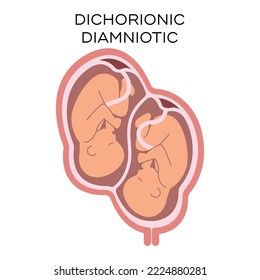 Dichorionic diamniotic twins vector illustration. Flat image of dizygotic fraternal twins. Multiple pregnancy, maternity concepts.