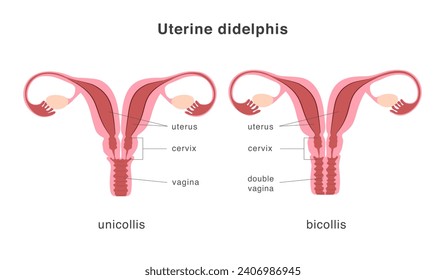 Estructura del útero humano didelphis de los tipos unicollis y bicollis. Septo profundo uterino como malformación uterina congénita. Anatomía gráfica.