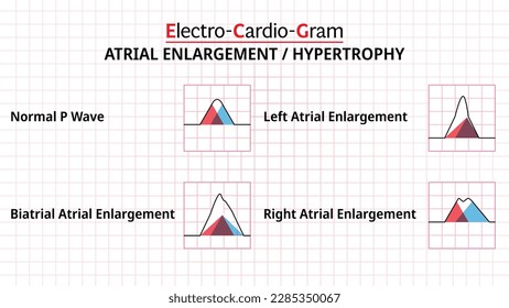 The Difference Abnormal P Wave - ECG Biatrial Enlargement, Right Atrial Erlagement, Left Atrial Enlargement - Electrocardiogram - Morphology P Wave - Vector Illustration svg