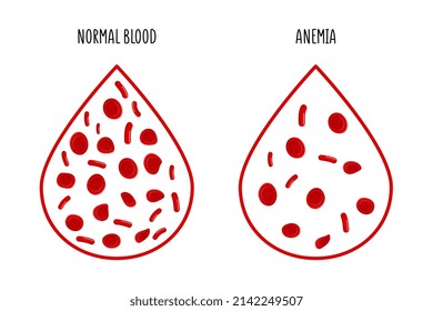 La diferencia entre la cantidad de anemia de glóbulos rojos y la normalidad. Ilustración sobre medicina.