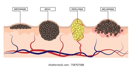 The difference between a birthmark, mole, papilloma and melanoma. Infographics. Vecor