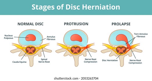 Difference between Bulging Disc and Herniated Disc. Stages of Spinal Disc extrusion. Simple Hernia graphic illustration in flat cartoon style.