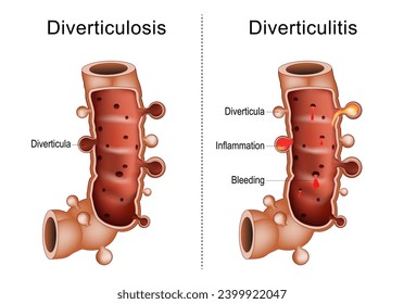 Difference between diverticulitis and diverticulosis colon. Close-up of a Part of a large intestine with Diverticula, Bleeding,  and Inflammation