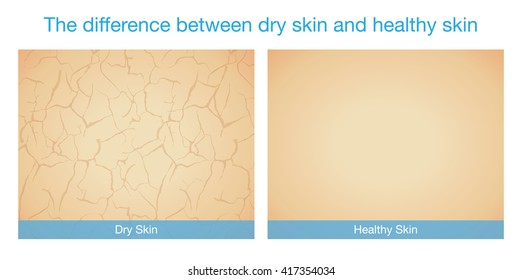 The Difference Between Dry Skin And Healthy Skin. This Illustration About Skincare.