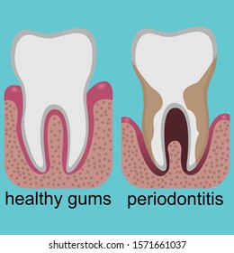 Difference between healthy gums and gums with periodontitis
